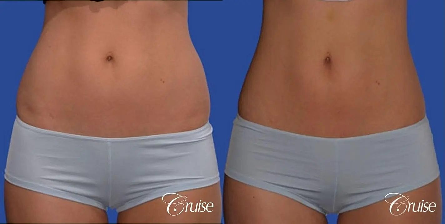 Liposuction Before & After