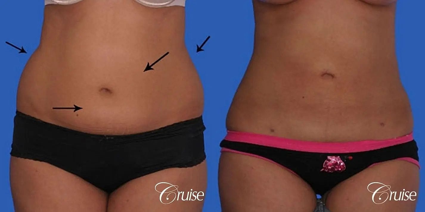 Liposuction Before & After
