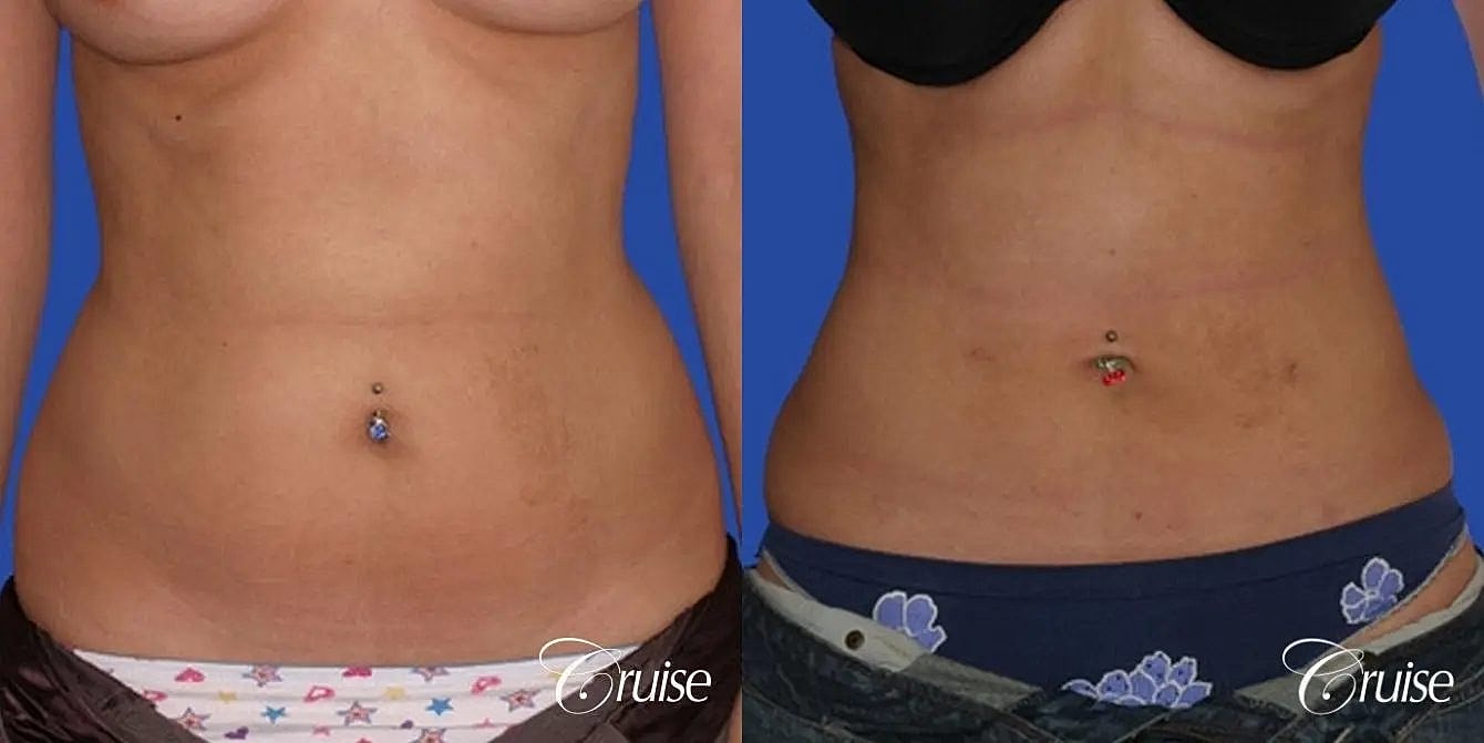 Liposuction Before & After