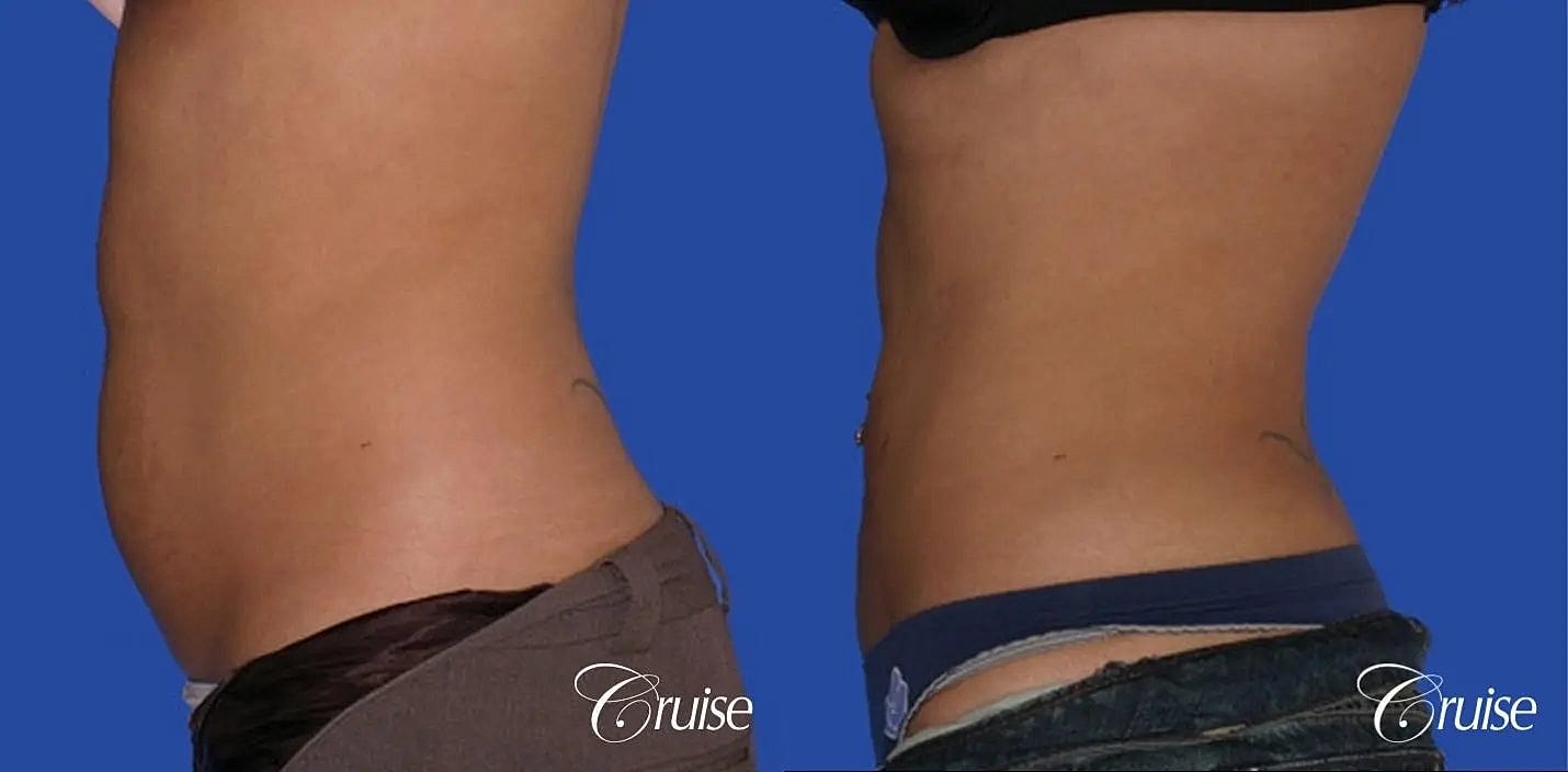 Liposuction Before & After