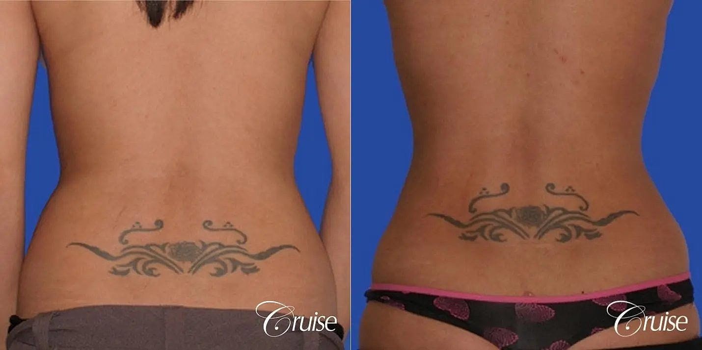 Liposuction Before & After