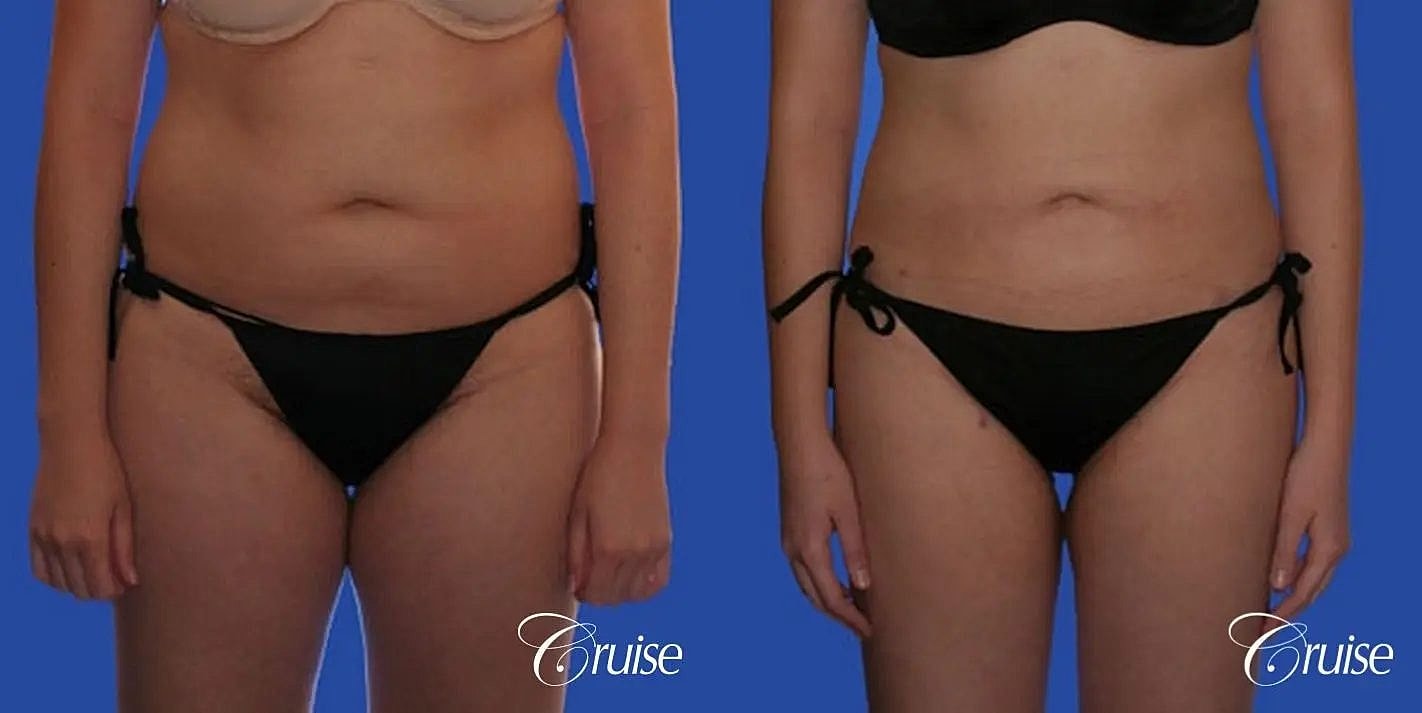 Liposuction Before & After