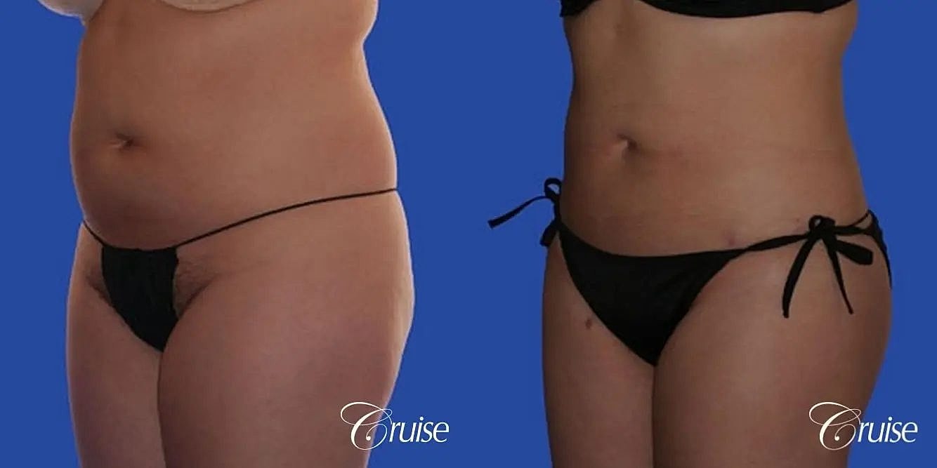Liposuction Before & After