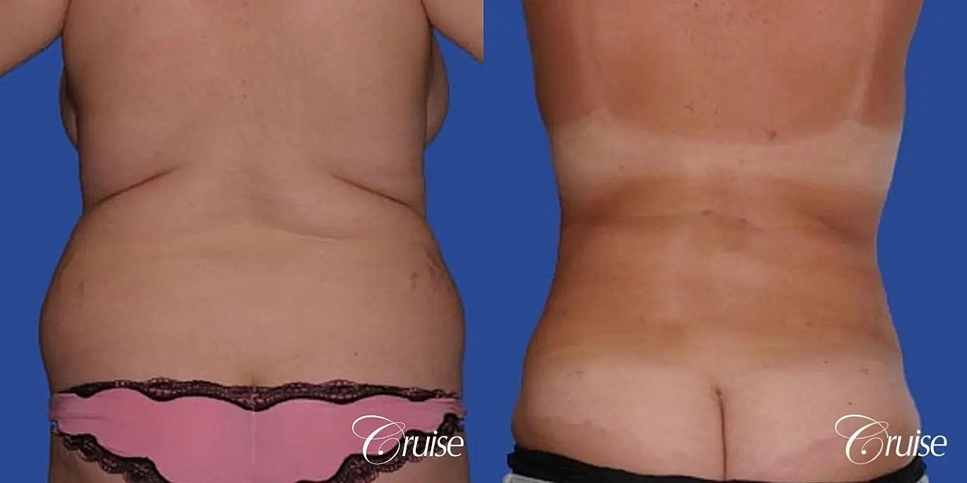 Liposuction Before & After