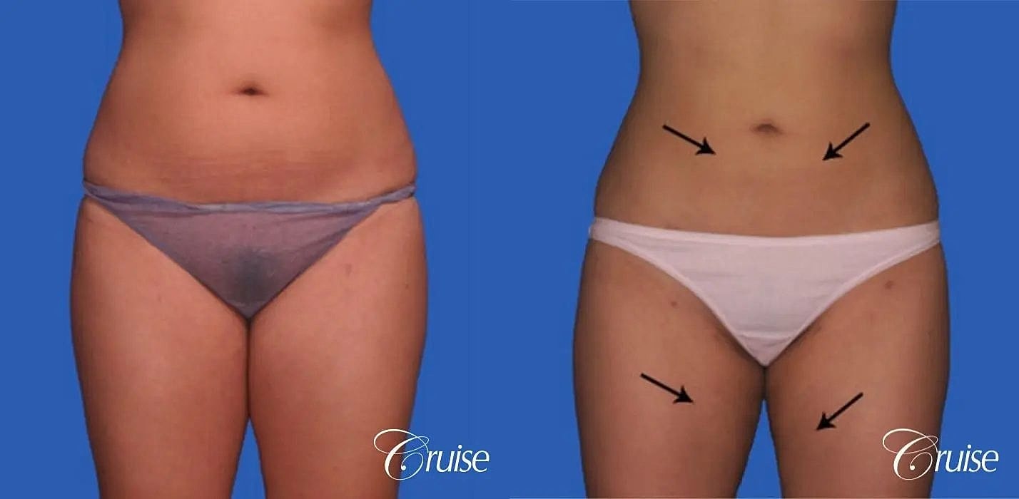 Liposuction Before & After