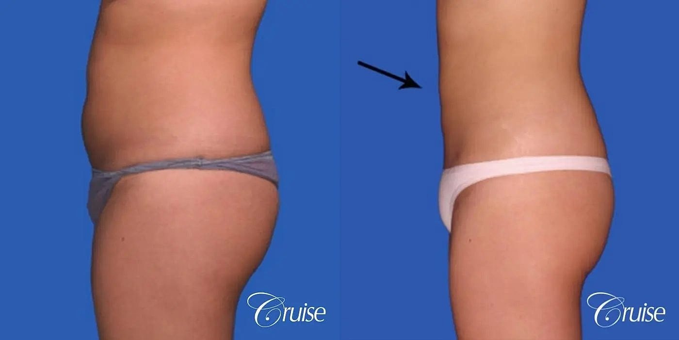 Liposuction Before & After