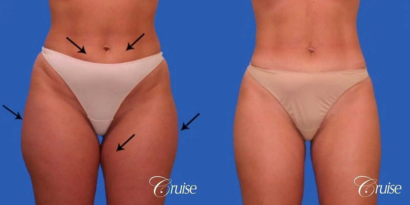 Liposuction Before & After