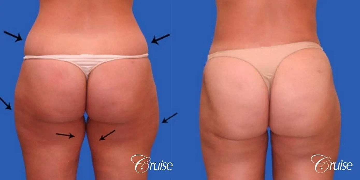Liposuction Before & After