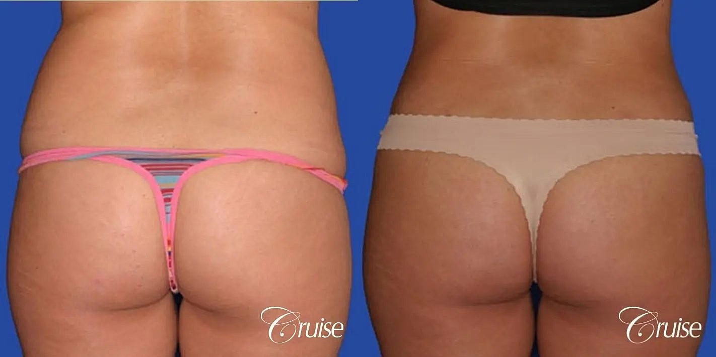 Liposuction Before & After