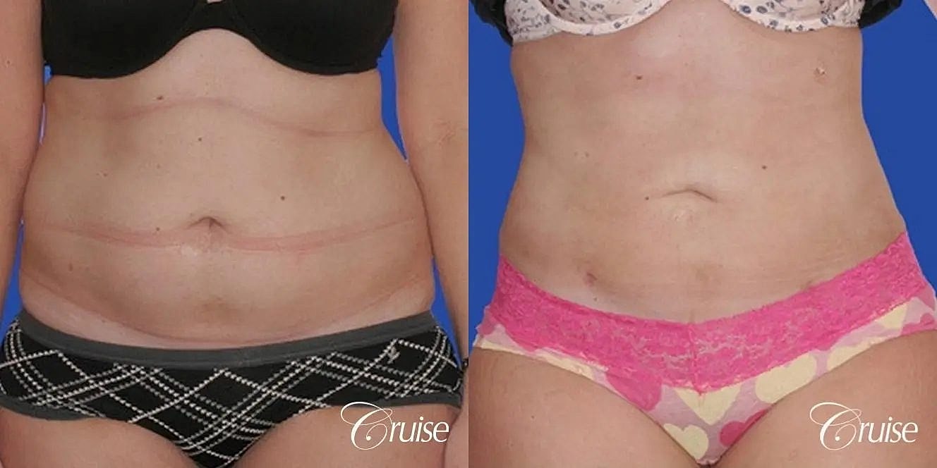 Liposuction Before & After