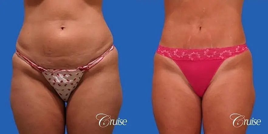 Liposuction Before & After