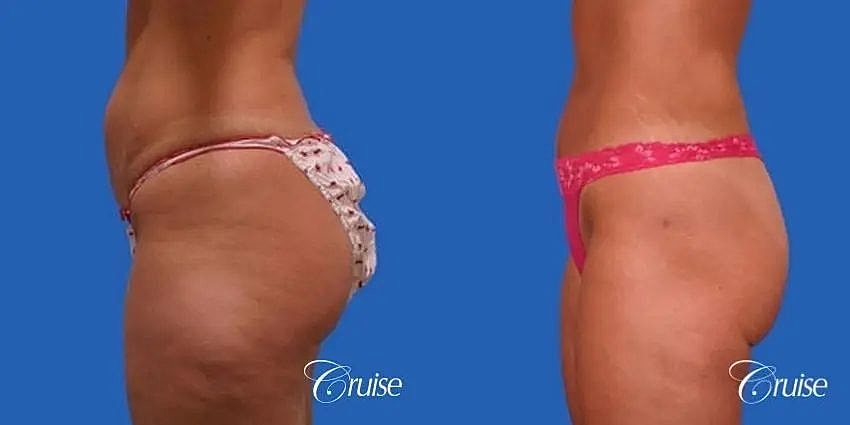 Liposuction Before & After