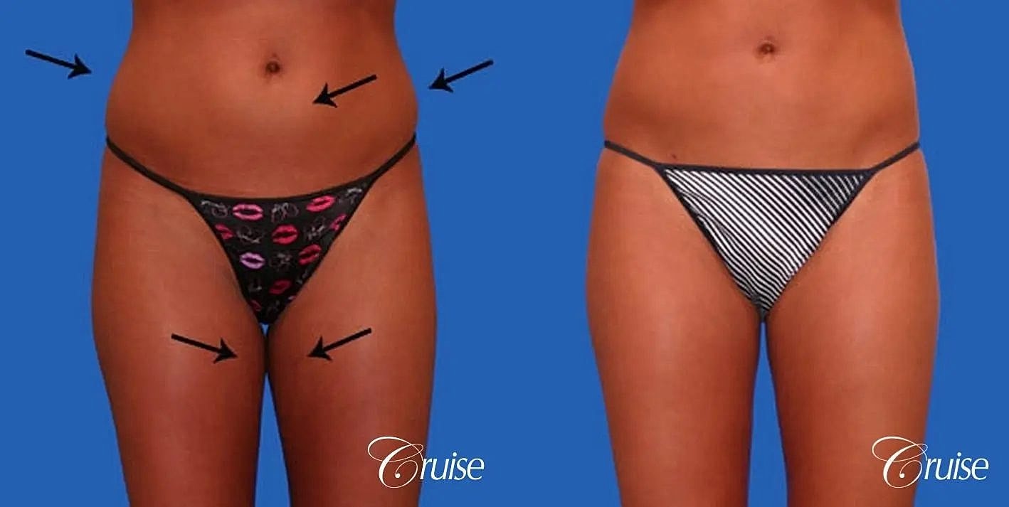 Liposuction Before & After