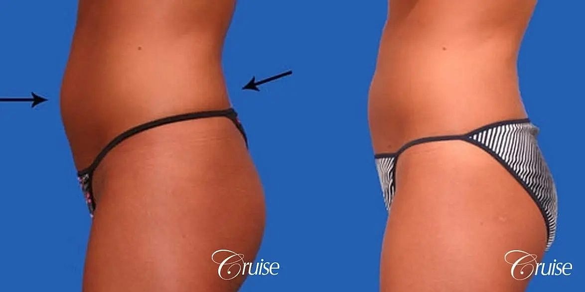 Liposuction Before & After