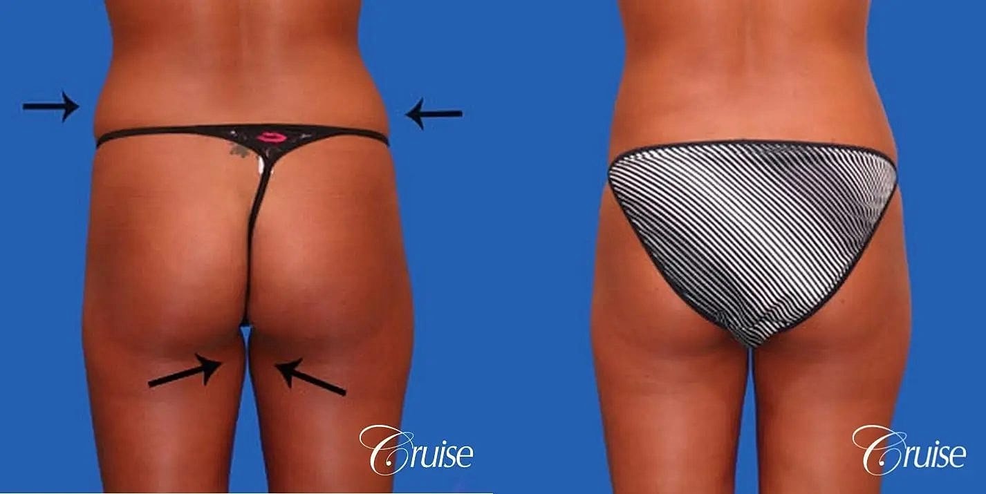 Liposuction Before & After