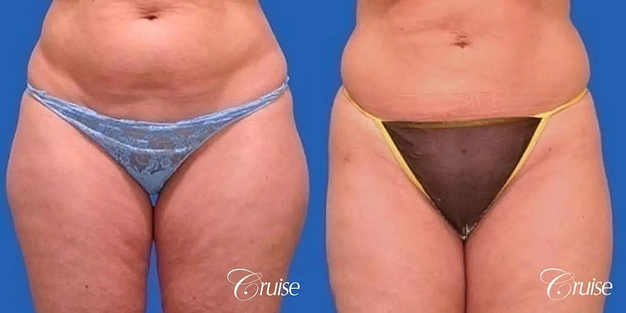 Liposuction Before & After