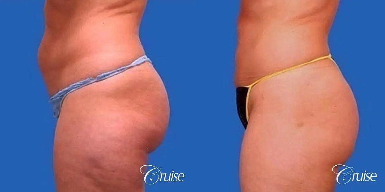 Liposuction Before & After