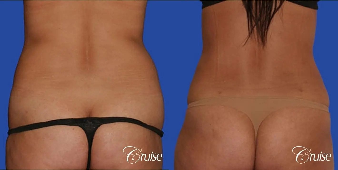 Liposuction Before & After
