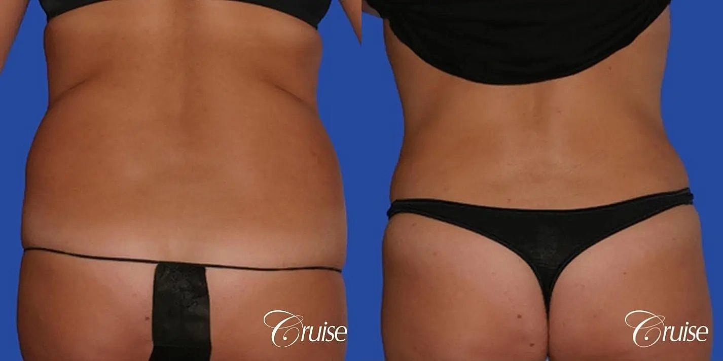 Liposuction Before & After