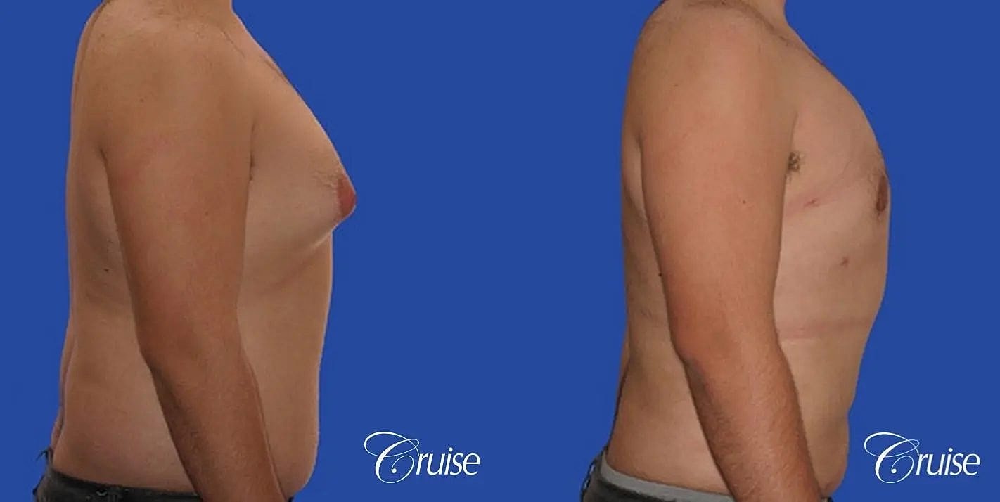 Liposuction Before & After