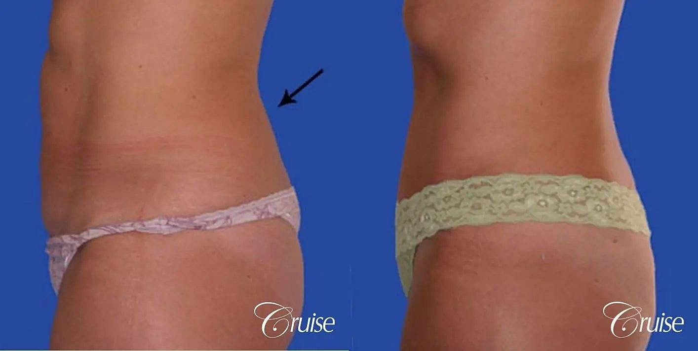 Liposuction Before & After