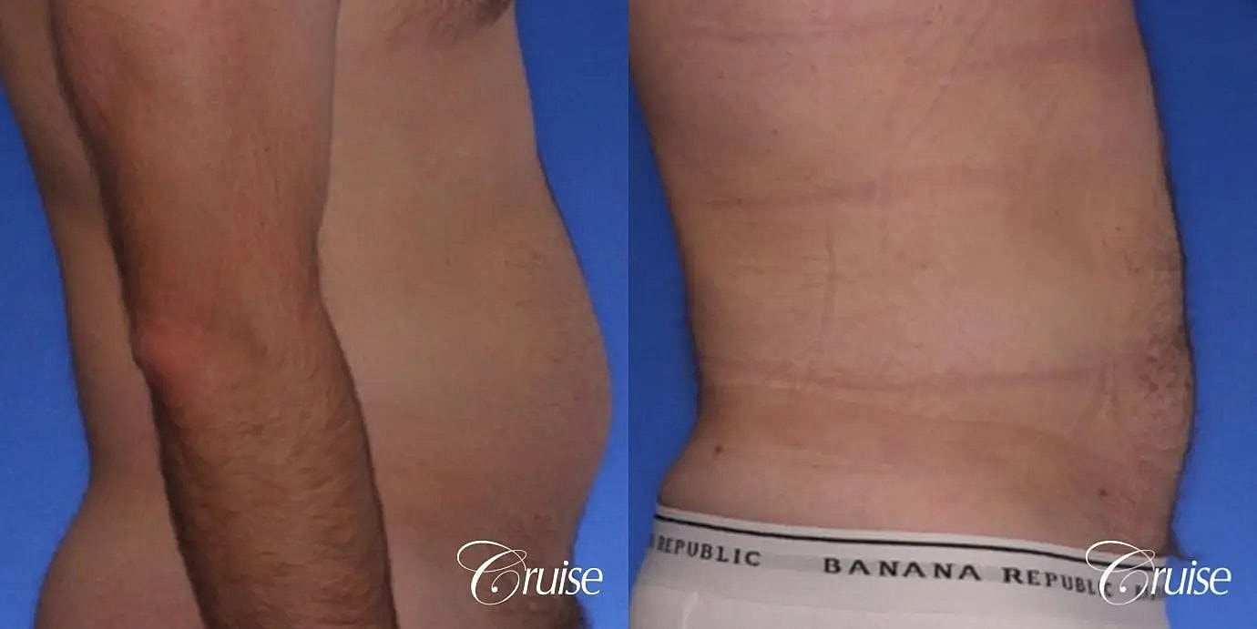 Liposuction Before & After