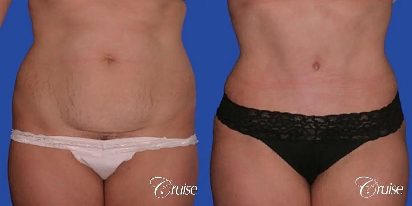 Liposuction Before & After