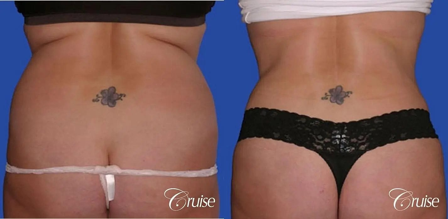 Liposuction Before & After