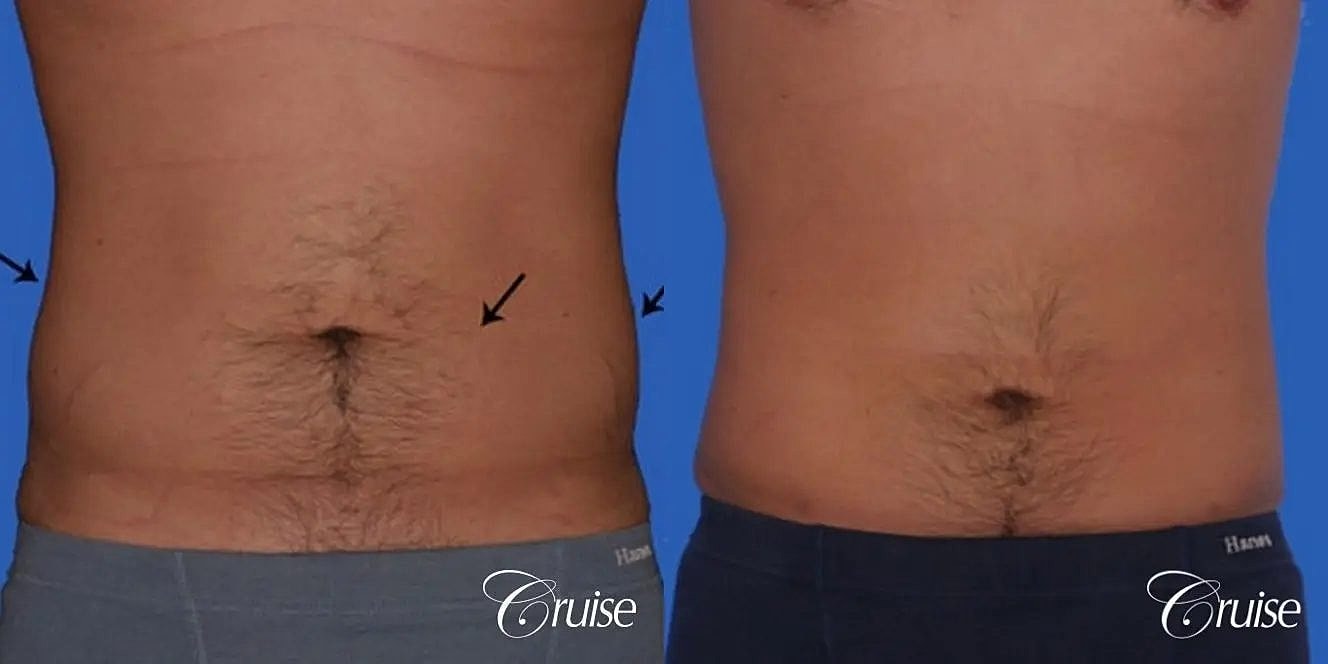 Liposuction Before & After