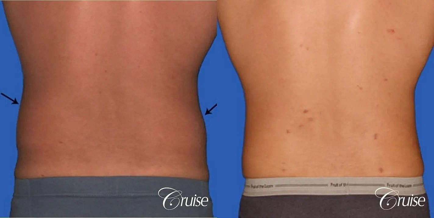 Liposuction Before & After