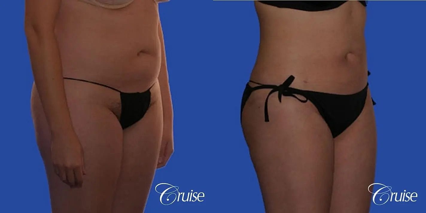 Liposuction Before & After