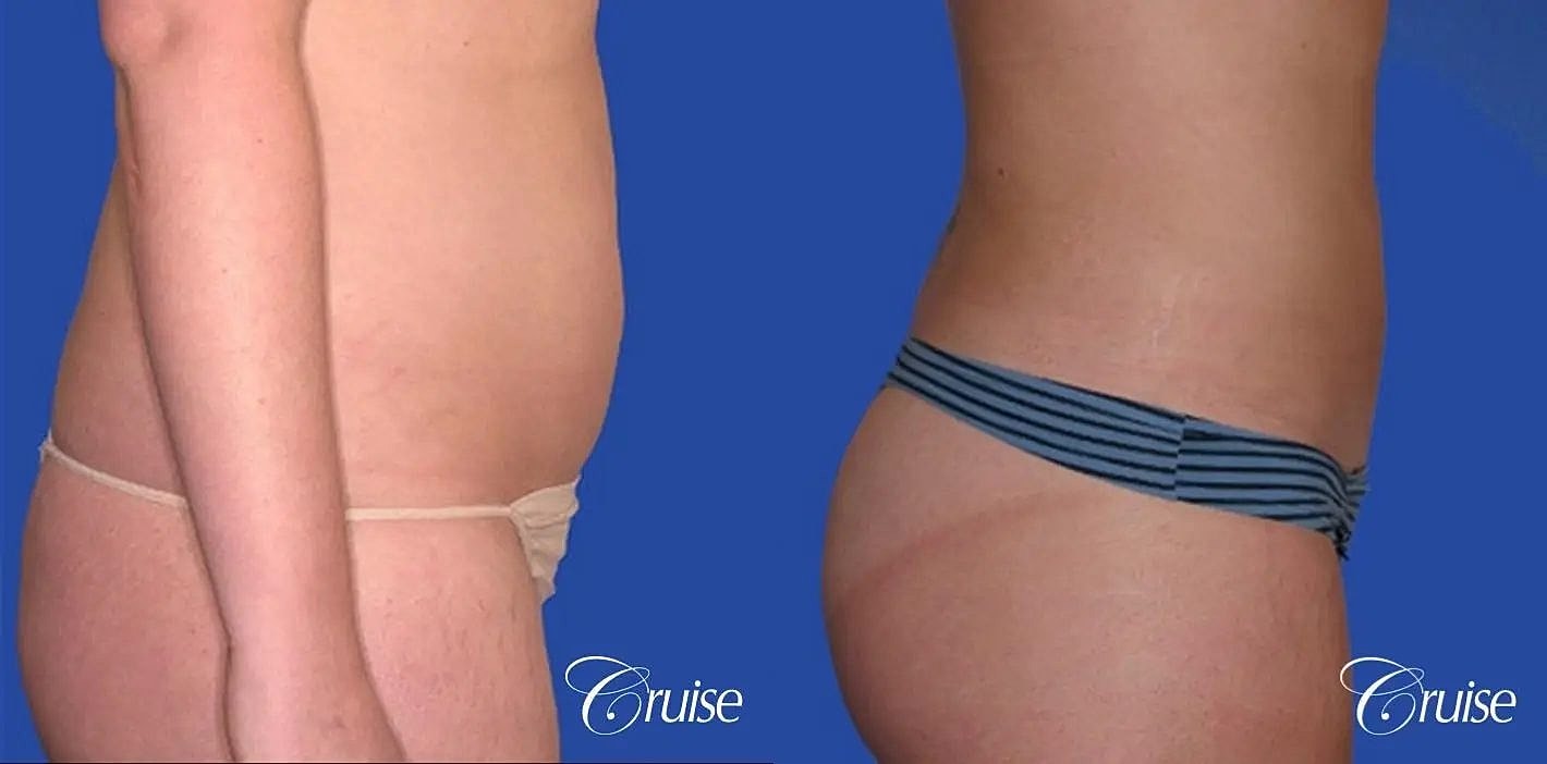Liposuction Before & After