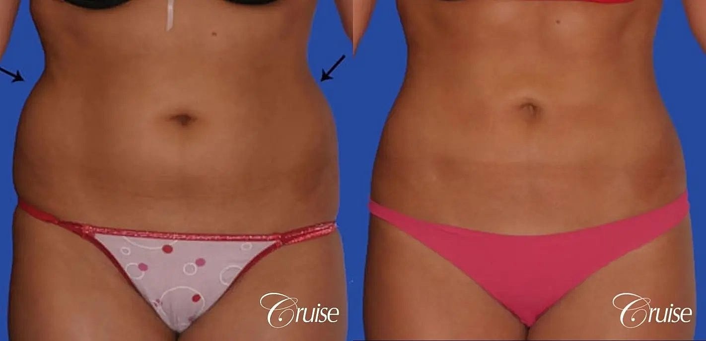 Liposuction Before & After