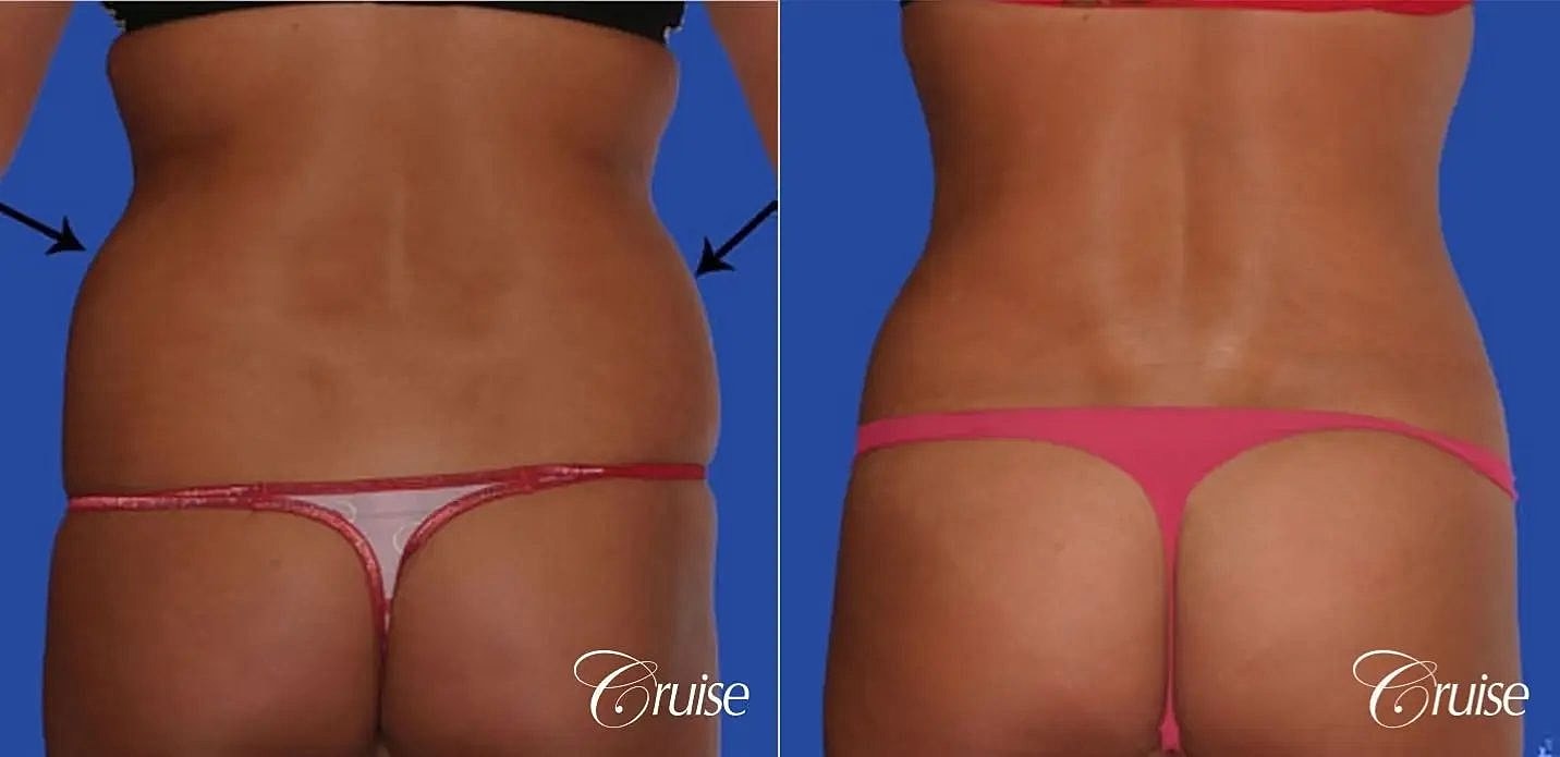 Liposuction Before & After