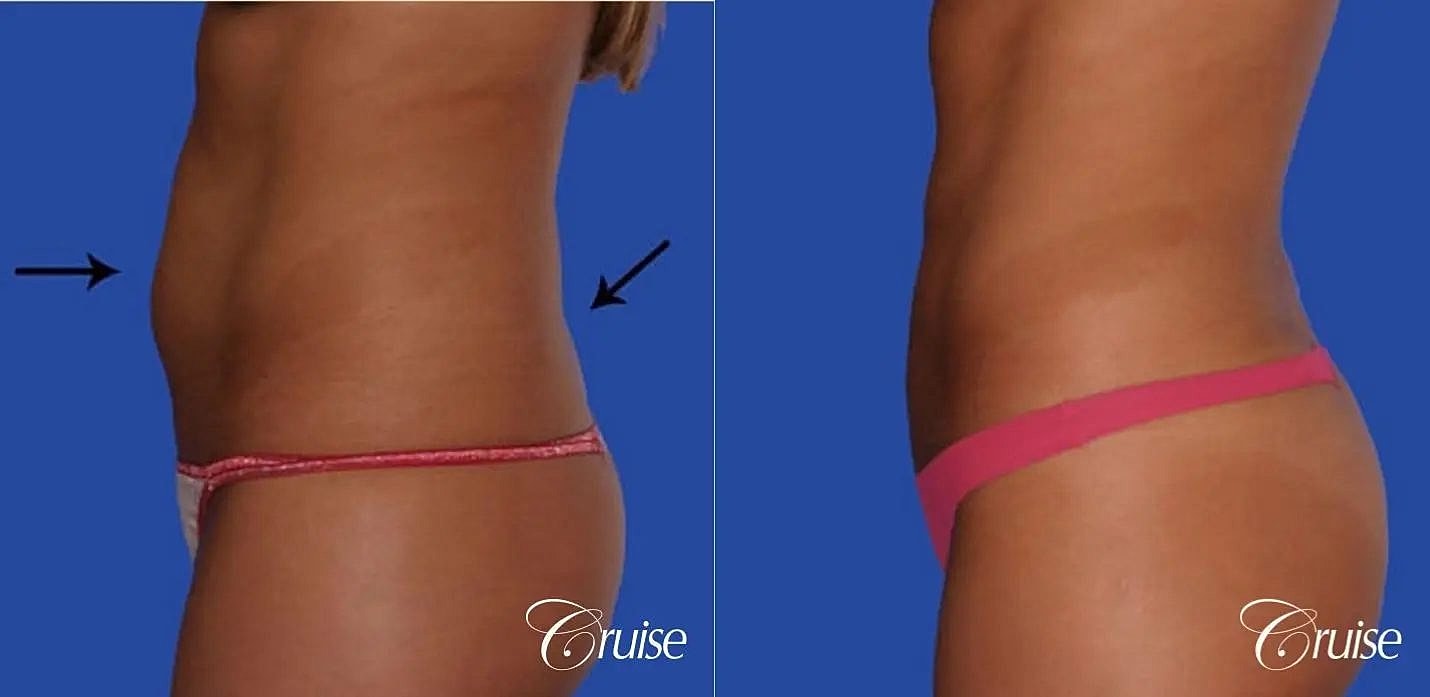 Liposuction Before & After