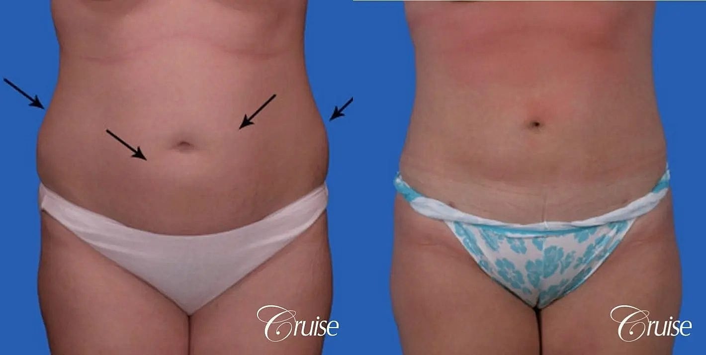 Liposuction Before & After