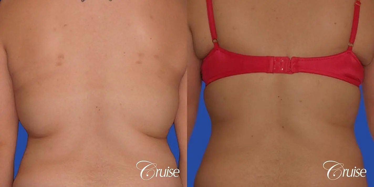 Liposuction Before & After