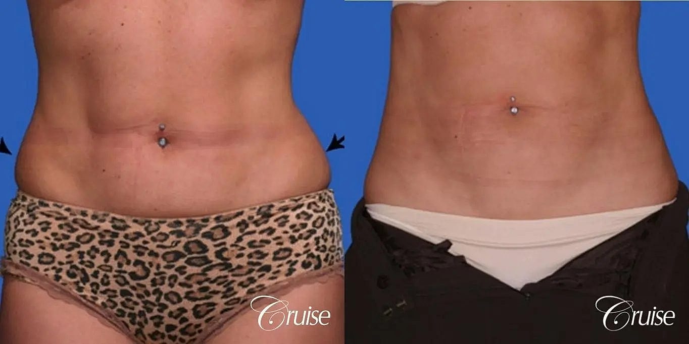 Liposuction Before & After