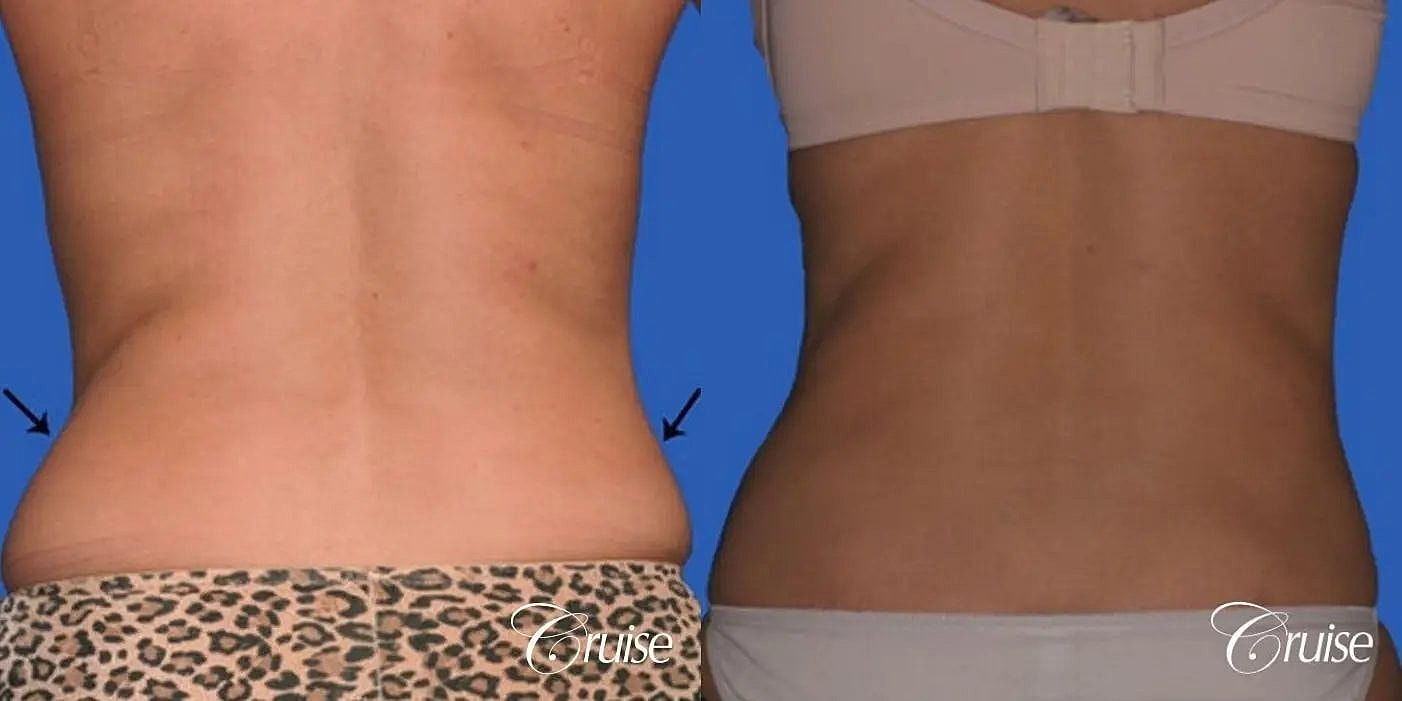 Liposuction Before & After