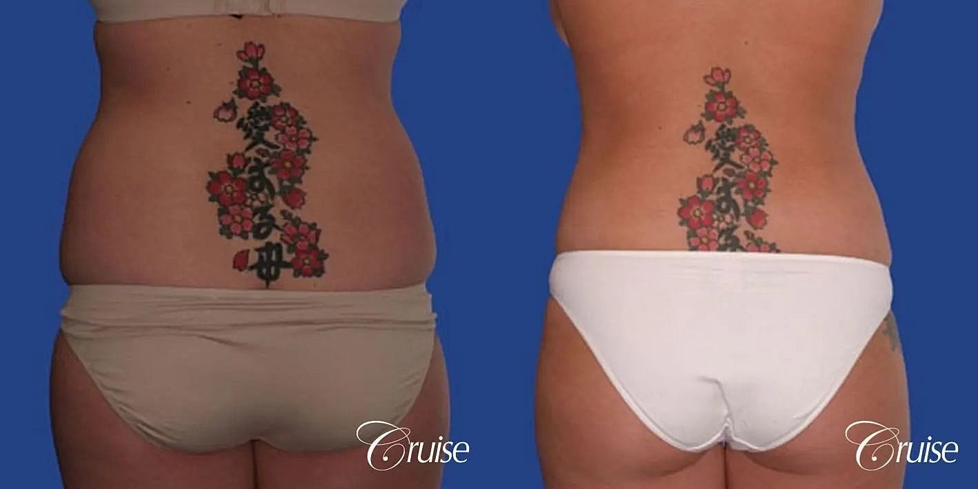 Liposuction Before & After