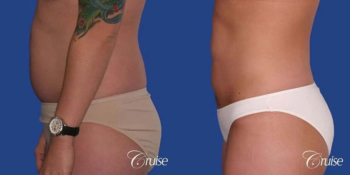 Liposuction Before & After