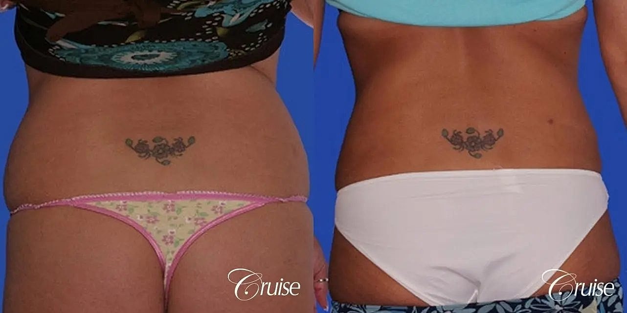 Liposuction Before & After