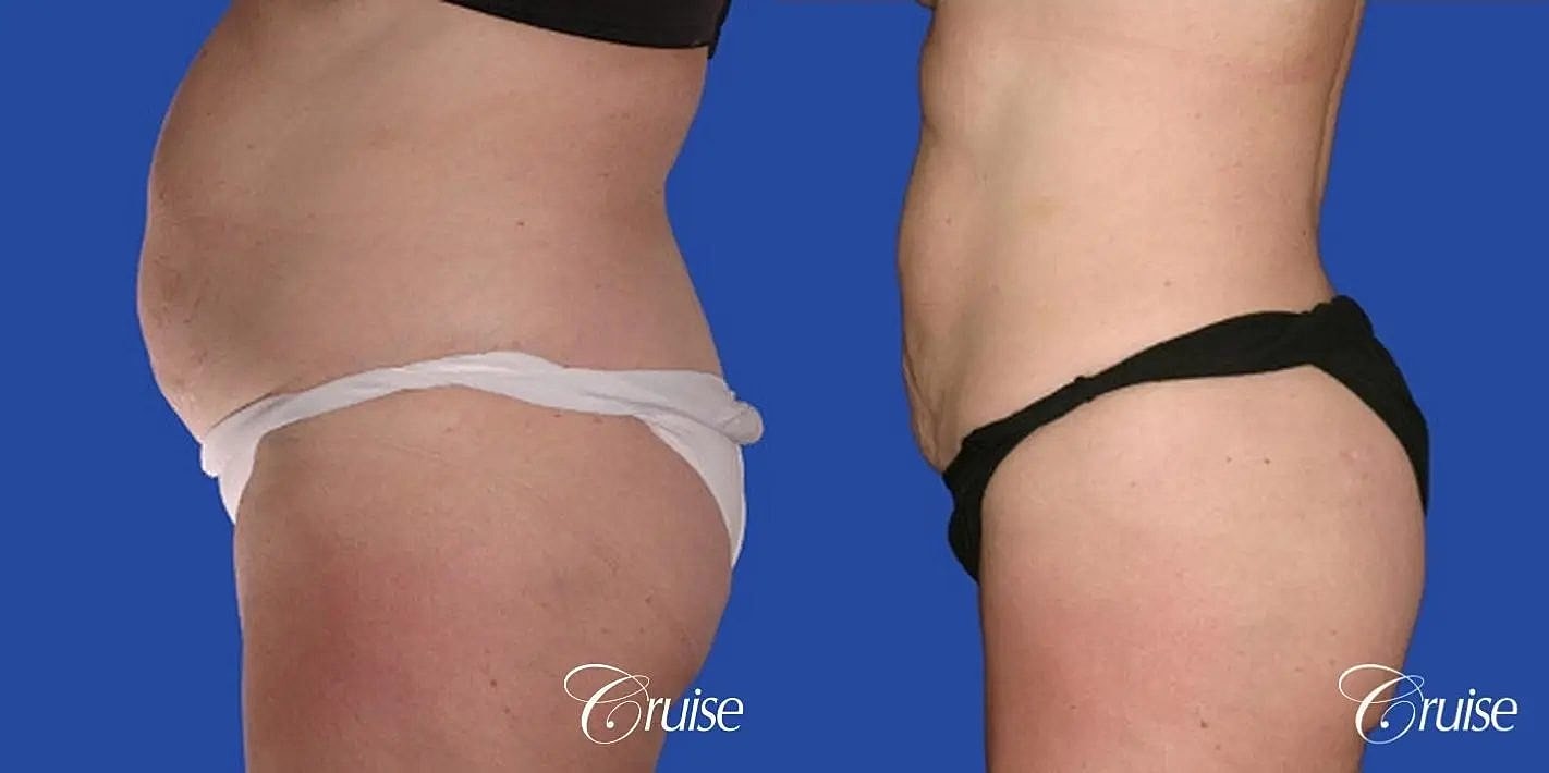 Liposuction Before & After