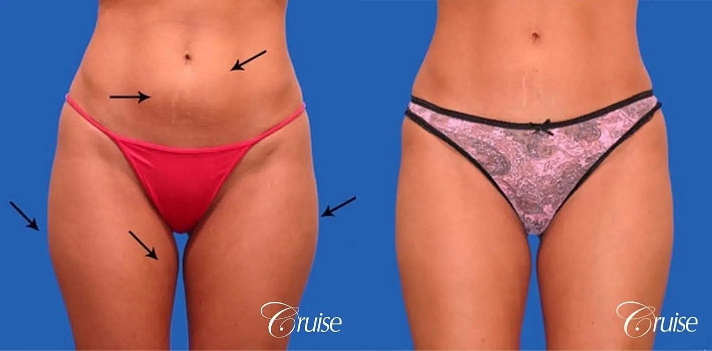 Liposuction Before & After
