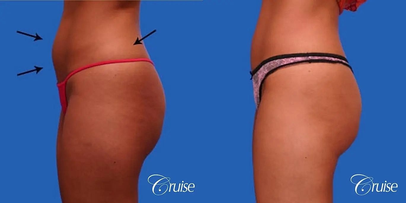 Liposuction Before & After