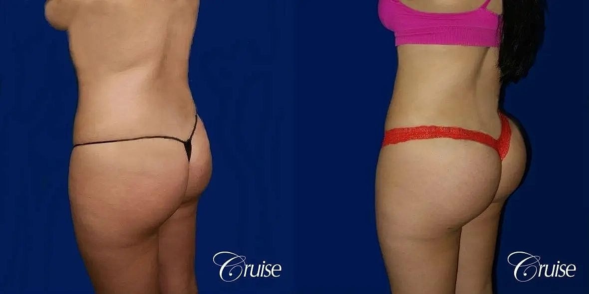 Liposuction Before & After