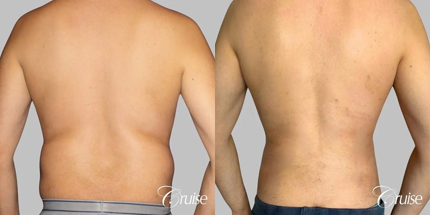 Liposuction Before & After