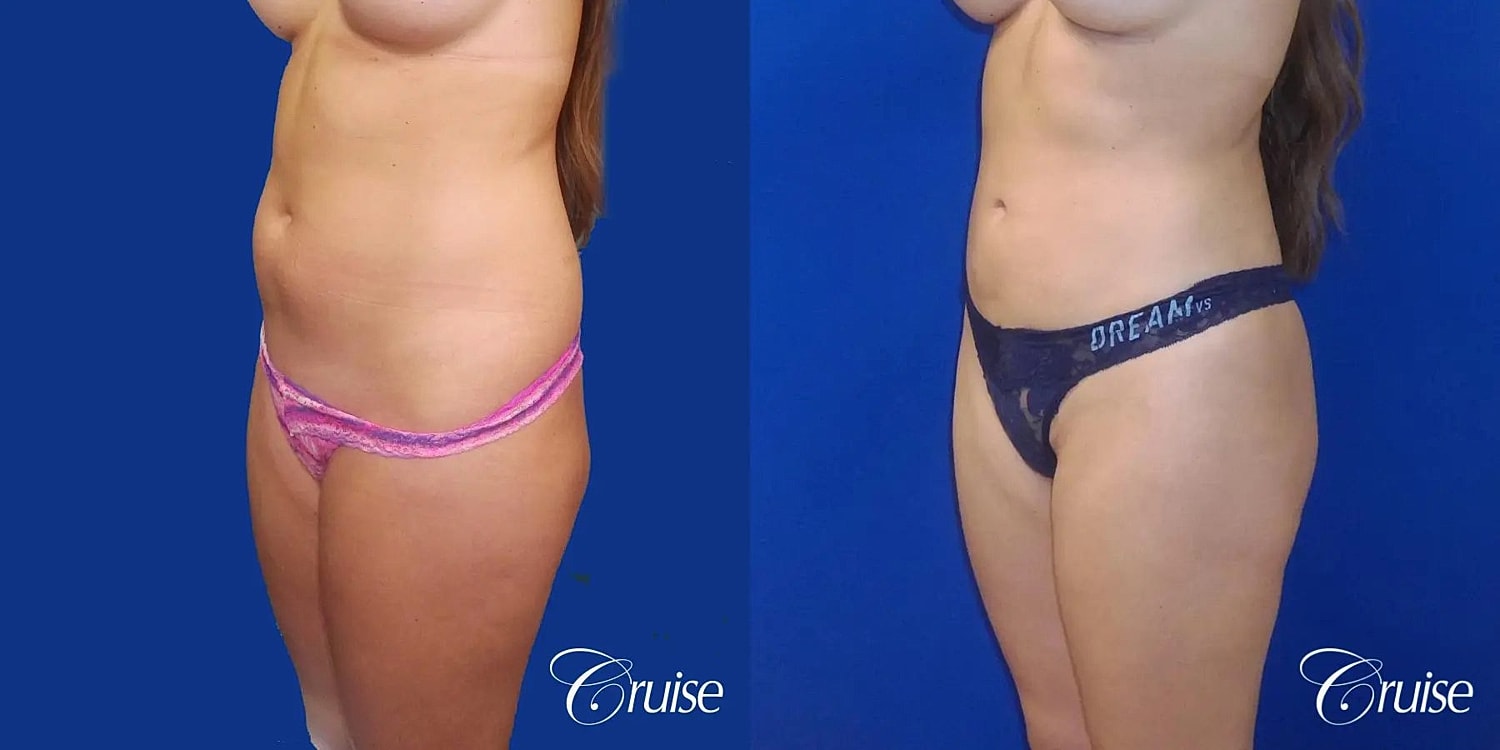 Liposuction Before & After