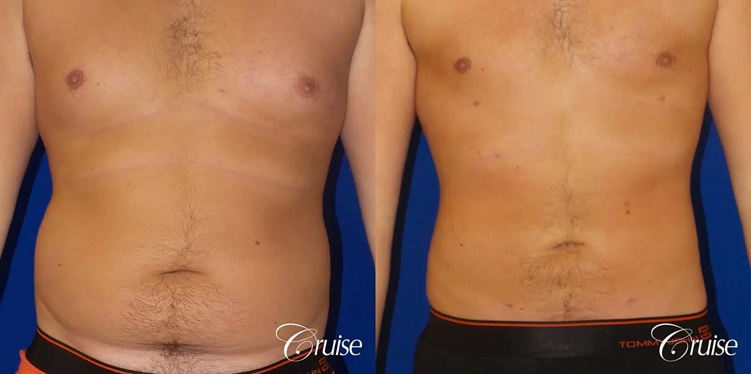Liposuction Before & After