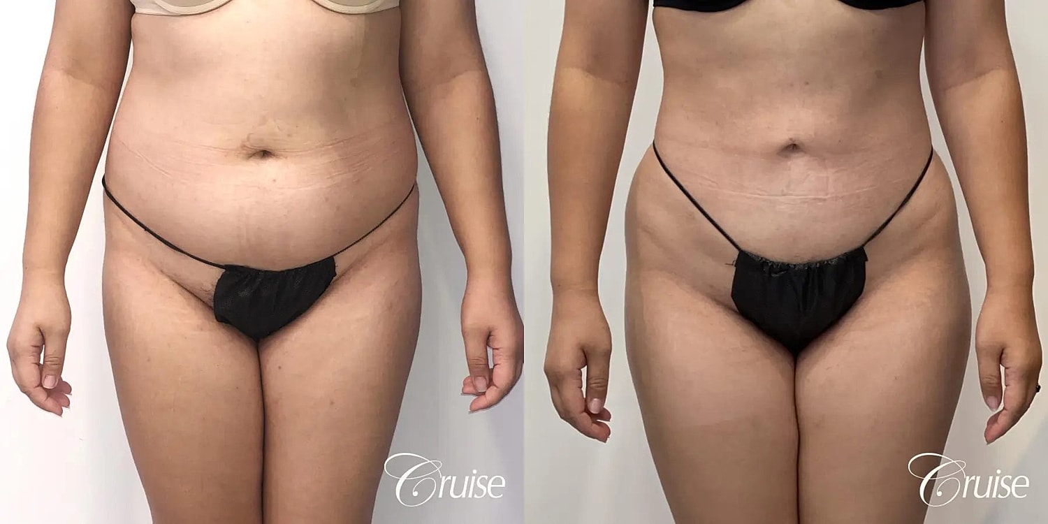Liposuction Before & After